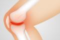 Hilfe bei Arthrose Knie (Gonarthrose, 