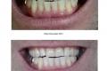 Weissere Zähne durch Ultraschall Emmi Dent